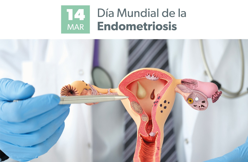 COMPRENDIENDO LA LUCHA CONTRA LA ENDOMETRIOSIS